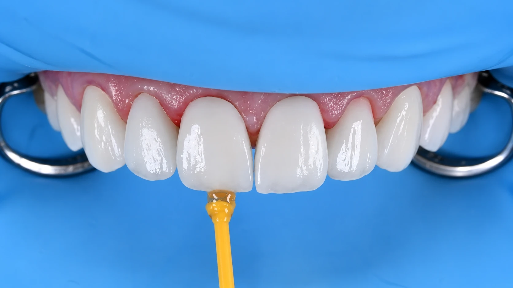 Planificarea estetică a zâmbetului