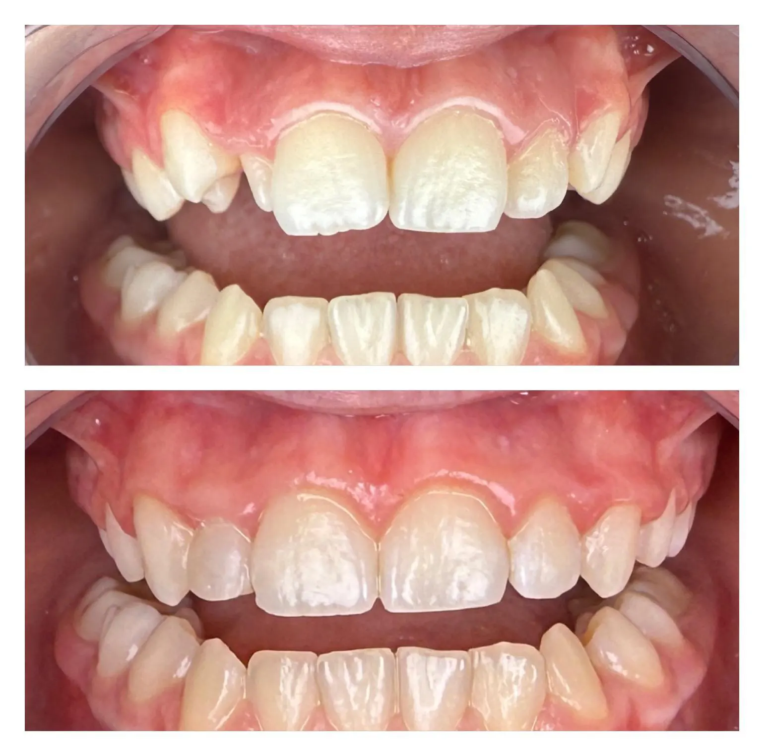 Înainte și după tratament ortodontic cu aparat dentar fix
