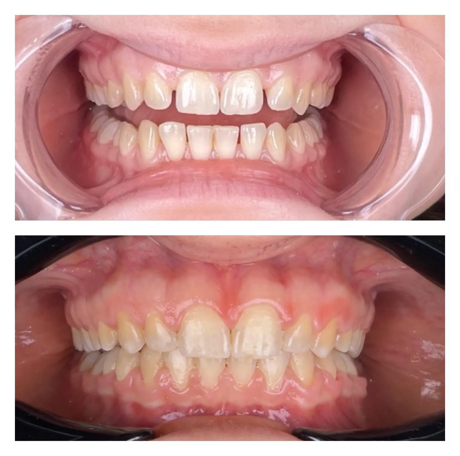 Înainte și după tratament ortodontic cu aparat dentar fix